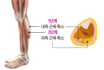 종아리 근육 해부 그림 + 단면 도식(1단계 내측 근육 축소 → 2단계 외측 근육 축소 화살표) — 1단계 내측 근육 축소 2단계 외측 근육 축소